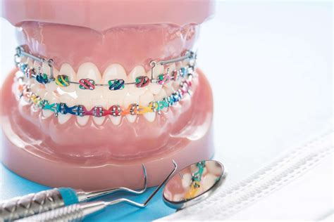 tratamiento de brackets periodontal